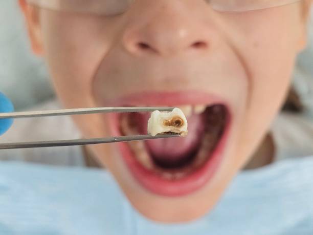 Best Emergency Treatment for Dental Infections or Abscesses in Eastern Goleta Valley, CA