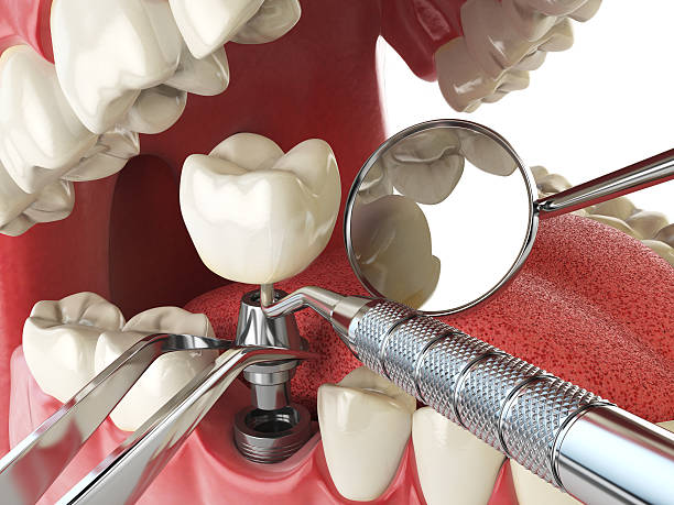 Best Emergency Dental Care for Broken or Chipped Teeth in Eastern Goleta Valley, CA